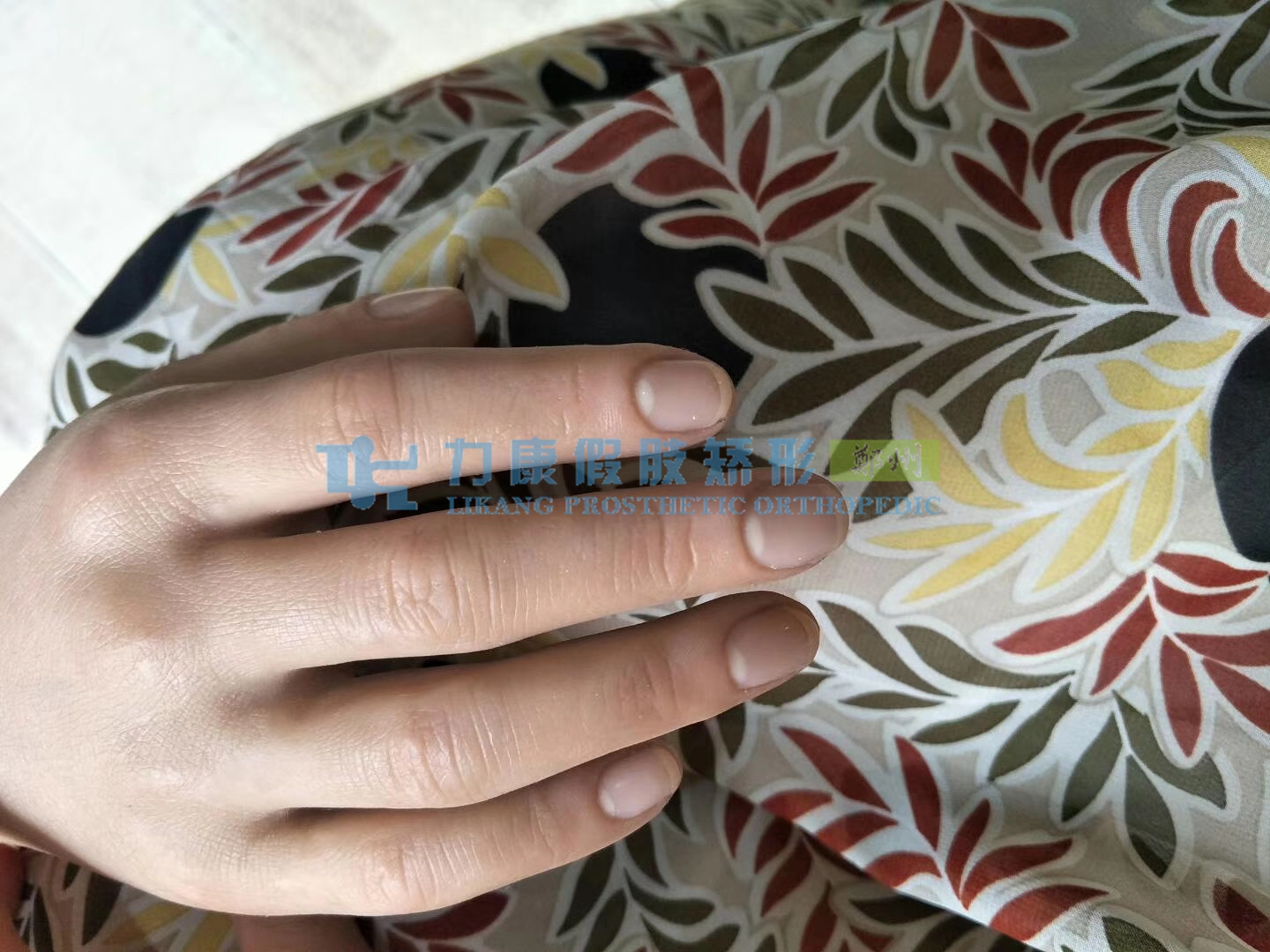 手指假肢價(jià)格多少如何進(jìn)行安裝(圖1)